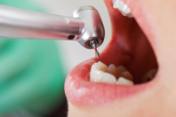 Best Lost Filling or Crown Replacement in Richmond, KY